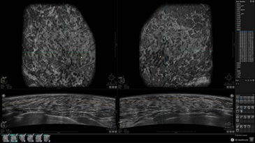 asound-somo v abus-invenia abus-clinical images-extremely dense tissue - normal study_jpg