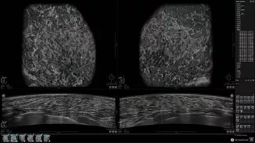 asound-somo v abus-invenia abus-clinical images-extremely dense tissue - normal study_jpg