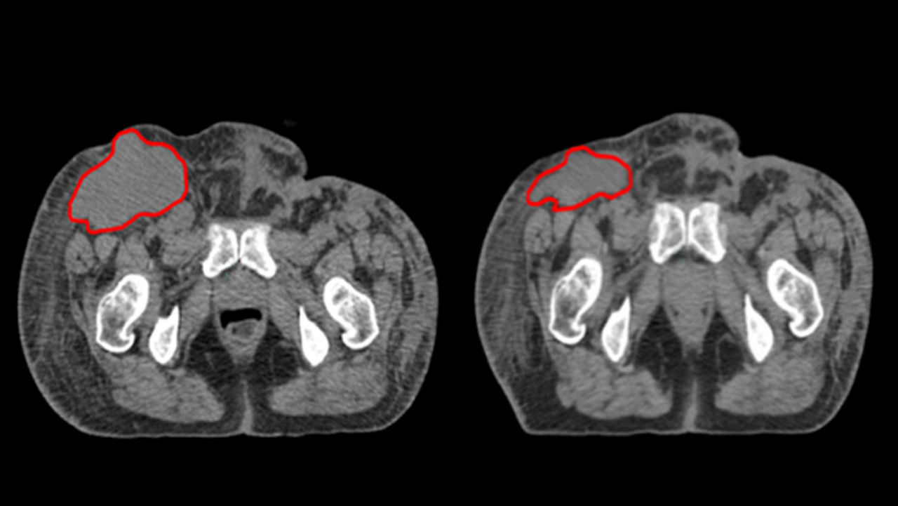 ations-advantagesim-md-gehc-advantagesim-md-ct-atlas-segmentation-adaptive-re-planning