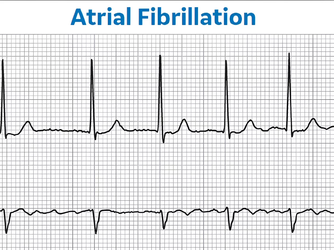 atrial-fibrillation-management-ArticleHero-ci-en