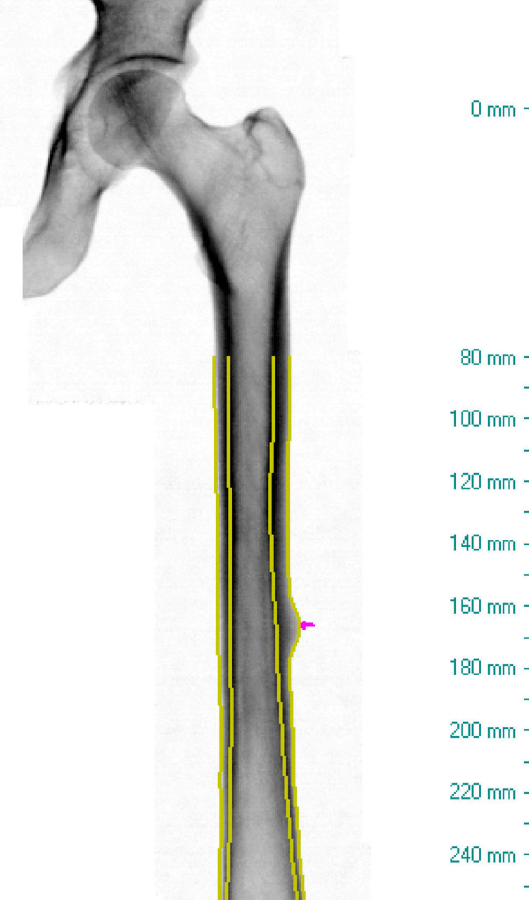 Atypical femur