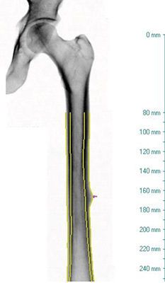 atypical_femur_fracture_report1