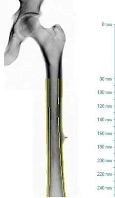 atypical_femur_fracture_report1