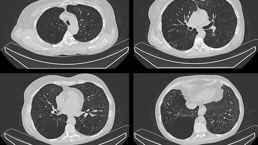aurora-pet-ct-lung-ct-ci-en