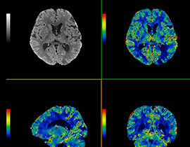 aw-ct-perfusion-4d-clinical-perf-neuro-270