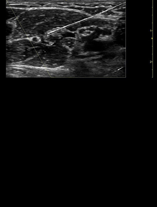 Axillary-Nerve-block-12-desktop