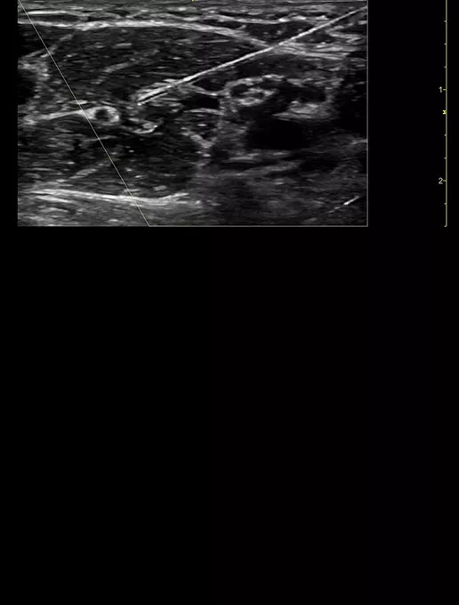 Axillary-Nerve-block-12-desktop