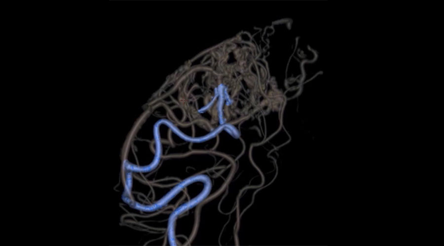 BAVM-clip1-900x500new