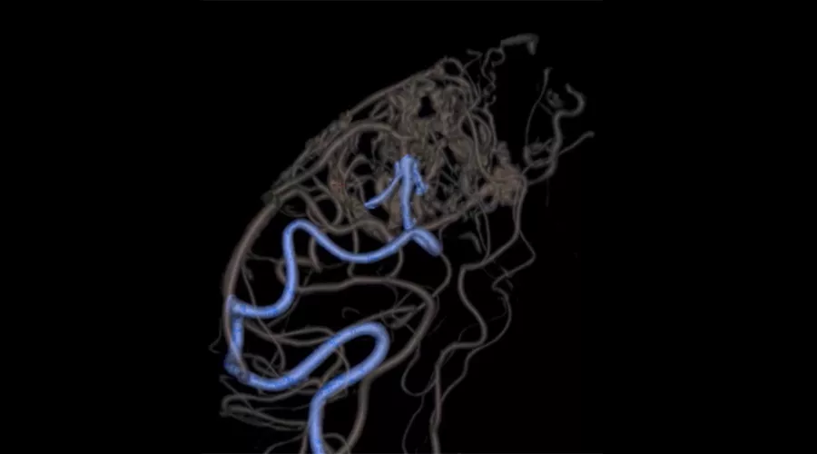 BAVM-clip1-900x500new