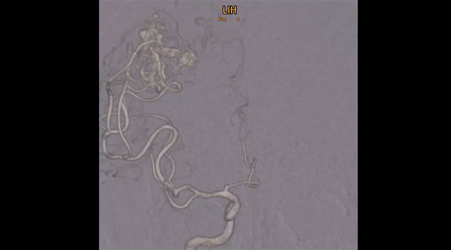BAVM-clip2-900x500new