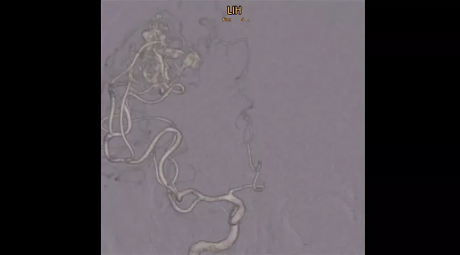 BAVM-clip2-900x500new
