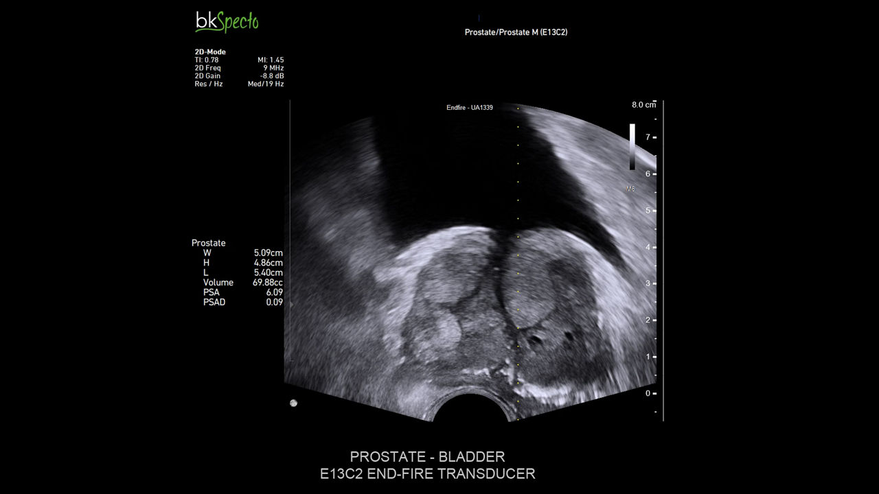 bkactive-ultrasound-system-sticky-hero-ba-1-en