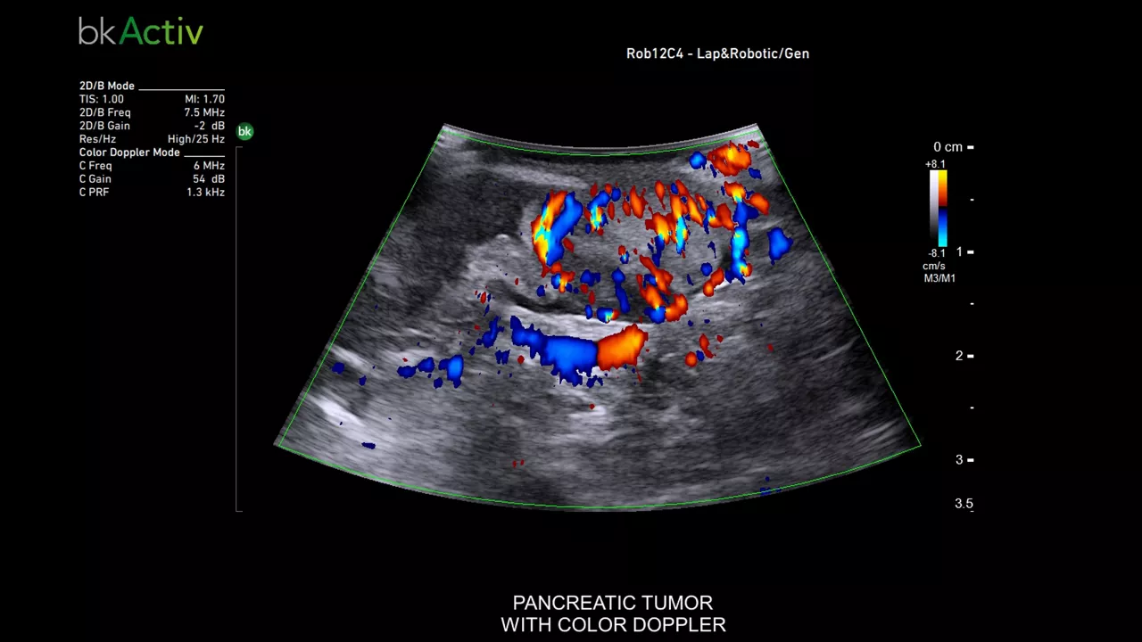bkactive-ultrasound-system-sticky-hero-ba-2-en