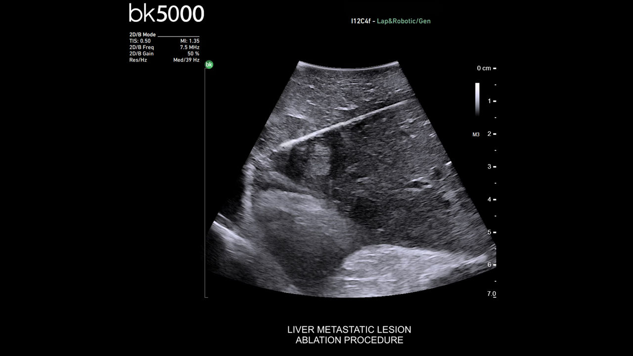 bkactive-ultrasound-system-sticky-hero-ba-3-en