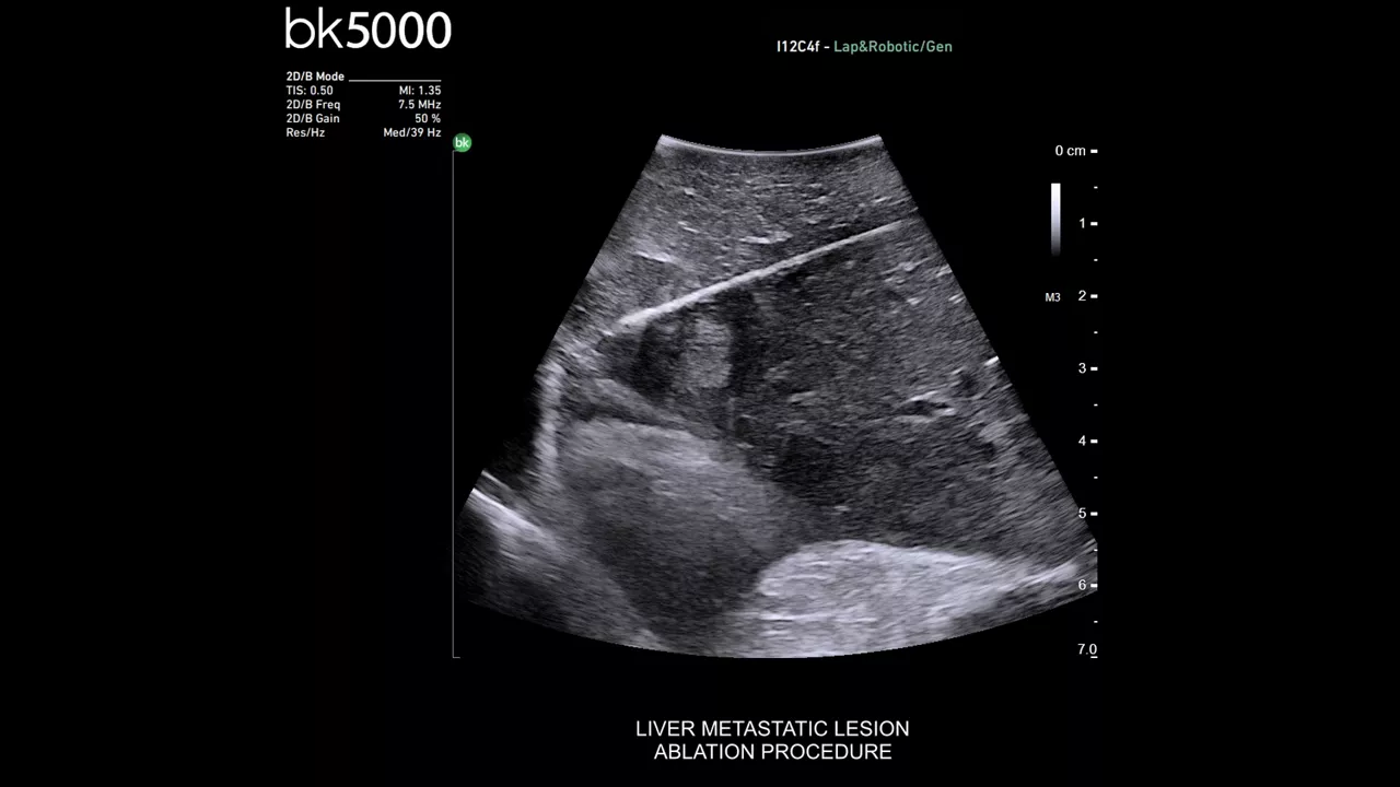 bkactive-ultrasound-system-sticky-hero-ba-3-en