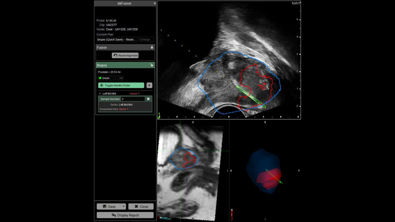 bkfusion-feature-card-transrectal-ci-en