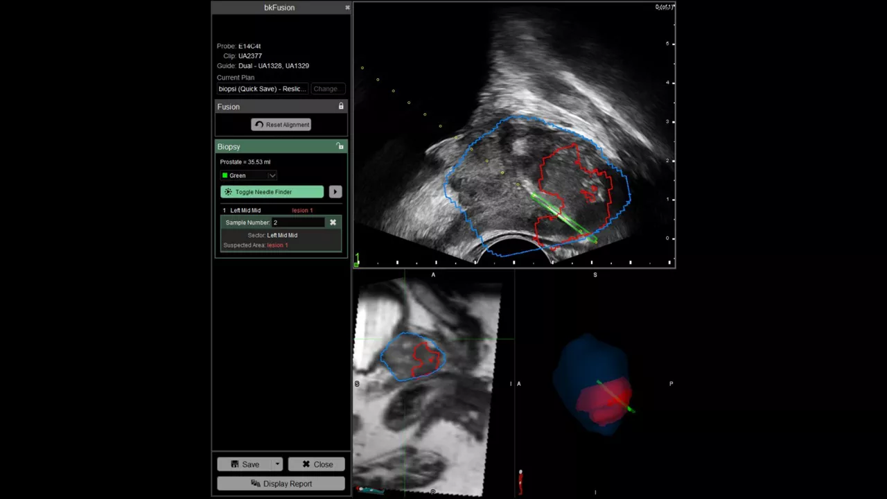 bkfusion-feature-card-transrectal-ci-en