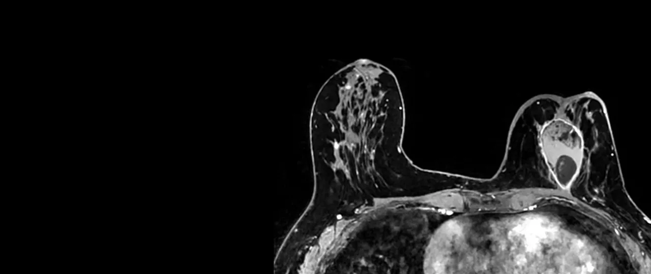 body-mri-for-signa-hero-ci-en