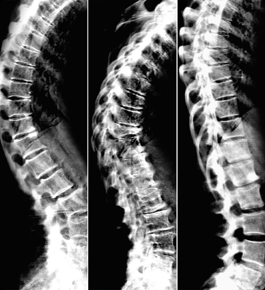 bone-health-dual-energy-vertebral-assessment-ba-en