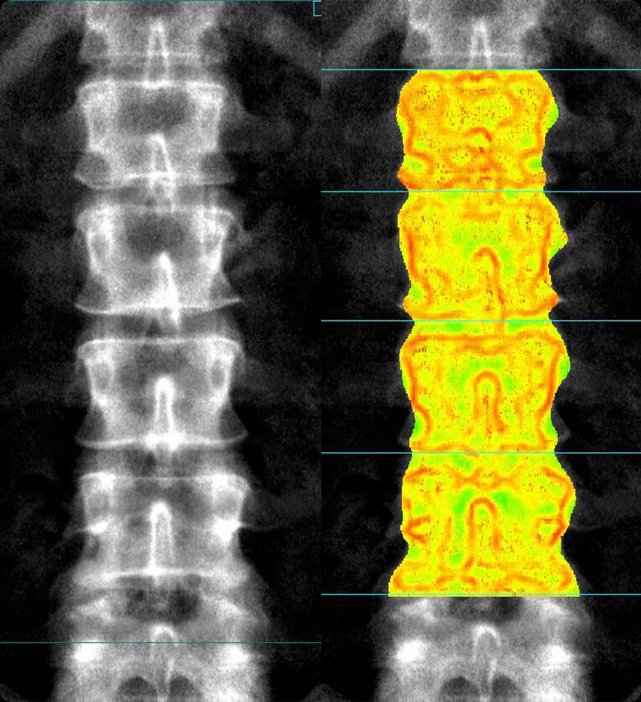 bone-health-integrated-trabecuiarr-ba-en