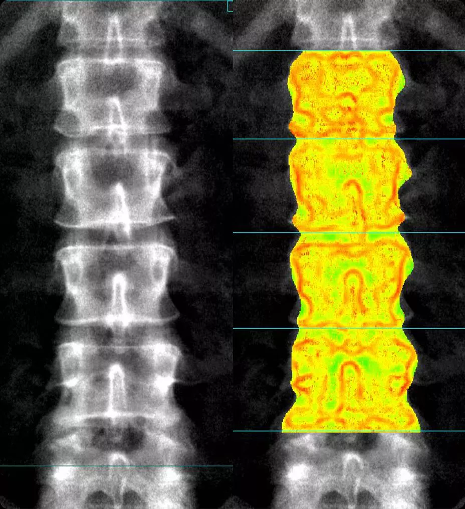 bone-health-integrated-trabecuiarr-ba-en
