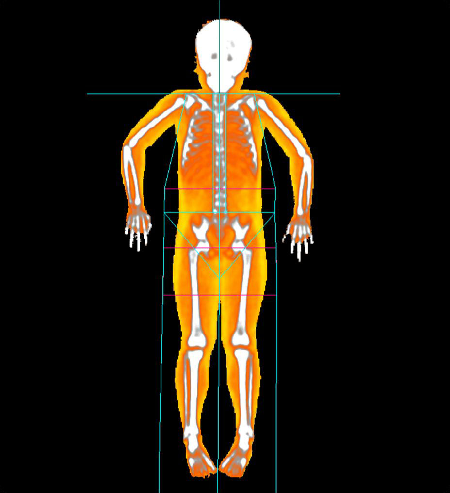bone-health-pediatric-ba-en