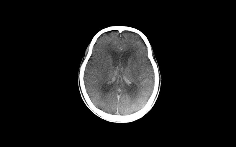 brain-soft-tissue-a