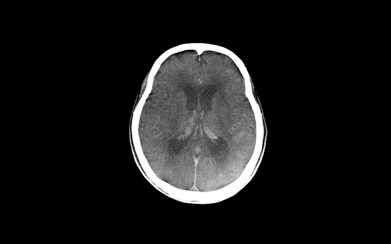 brain-soft-tissue-a