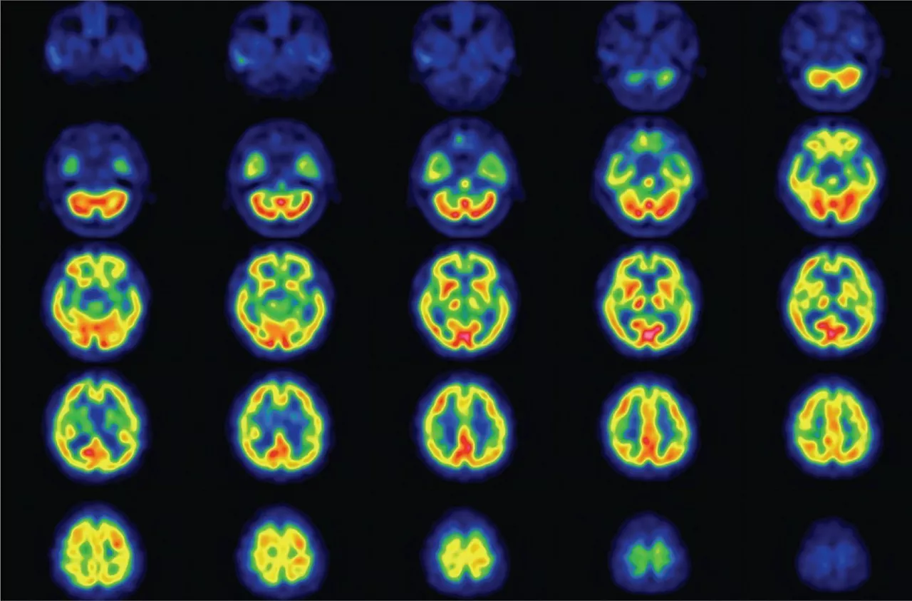 Brain_Scan