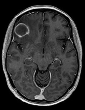 BrainedMRIenhancedimage
