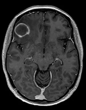 BrainedMRIenhancedimage