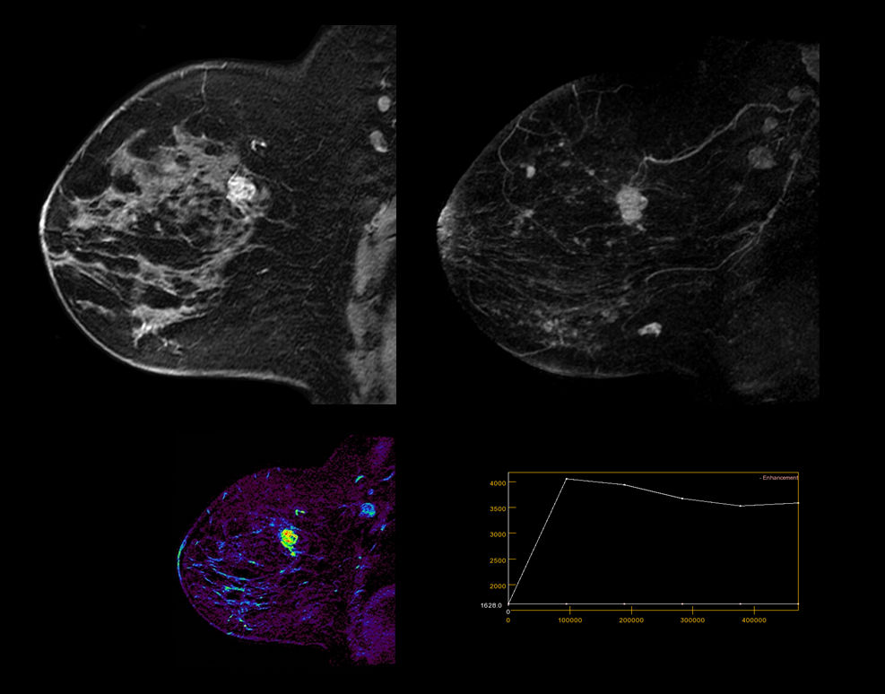 Breast_VIBRANT_Pioneer1