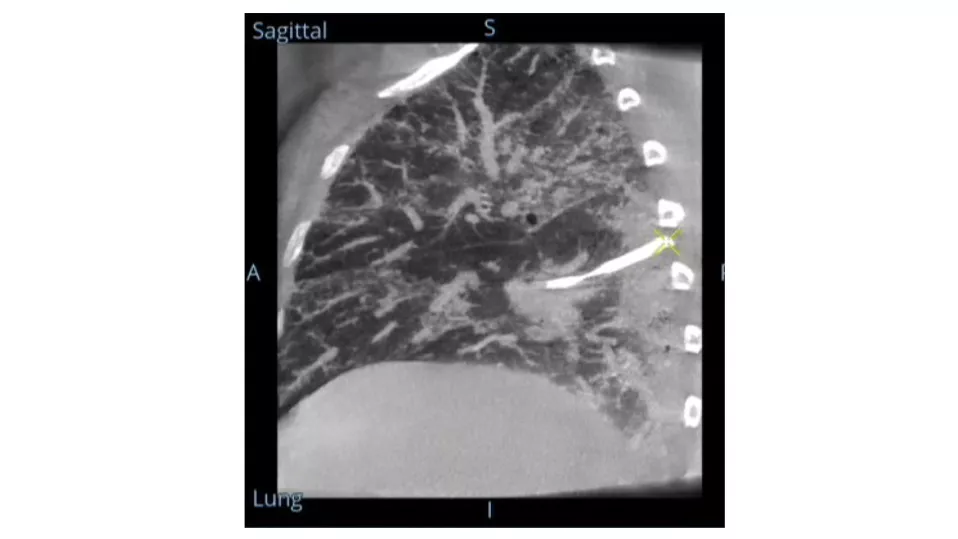 Bronchoscopy-new