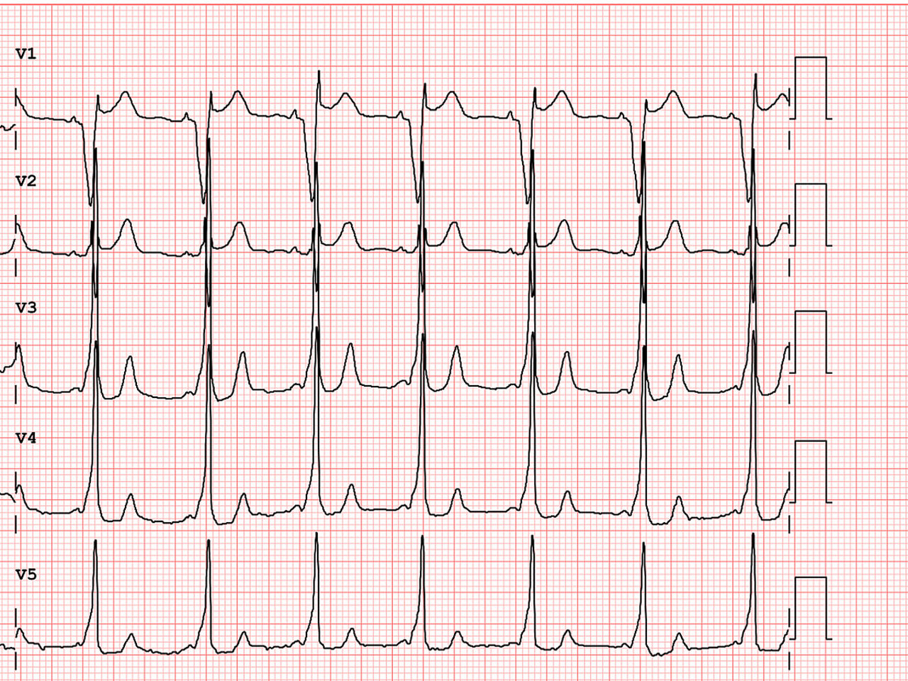 brugada-pattern-ecg-ArticleHero-ci-en