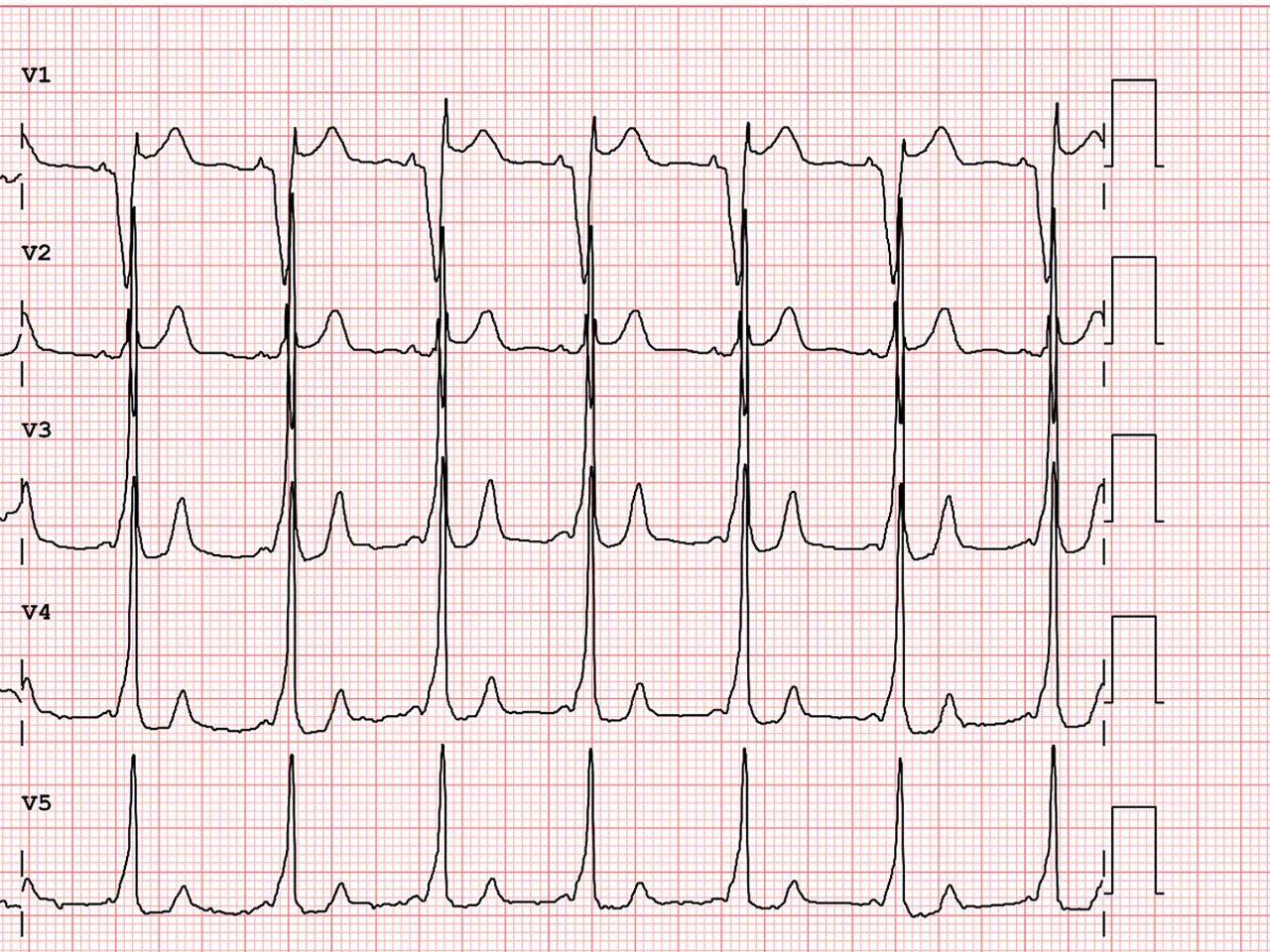 brugada-pattern-ecg-ArticleHero-ci-en