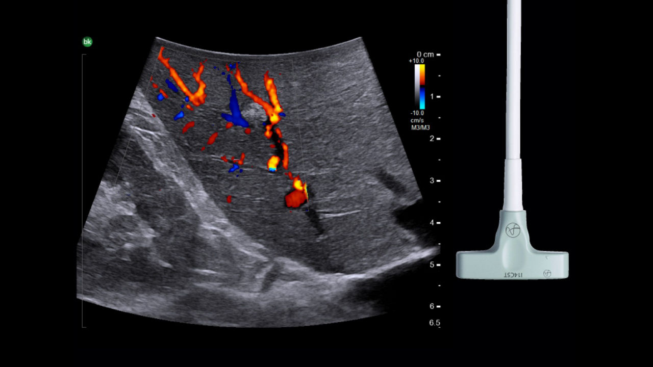 card1-half-width-resection-ultrasound