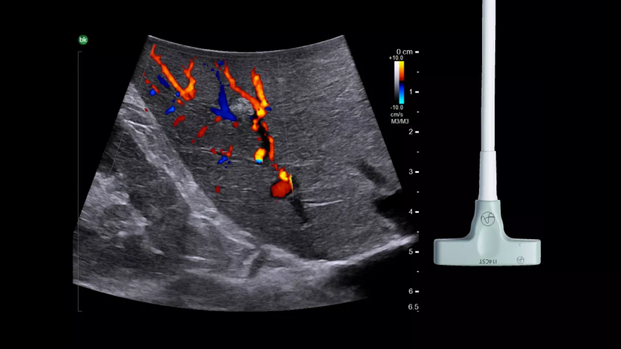 card1-half-width-resection-ultrasound