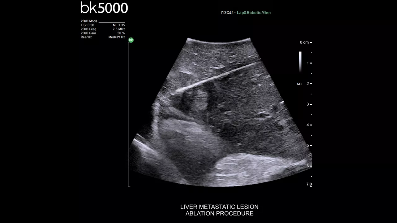 card2-half-width-ablation-imaging