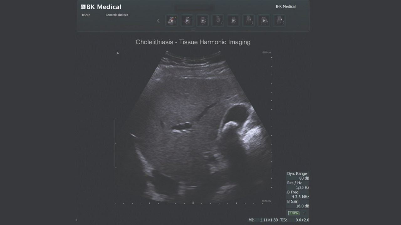 card3-half-width-cholecystectomy-ultrasound