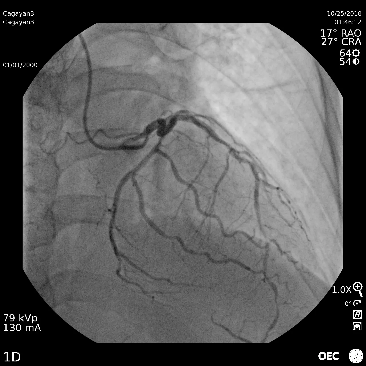 Cardiac Angiogram