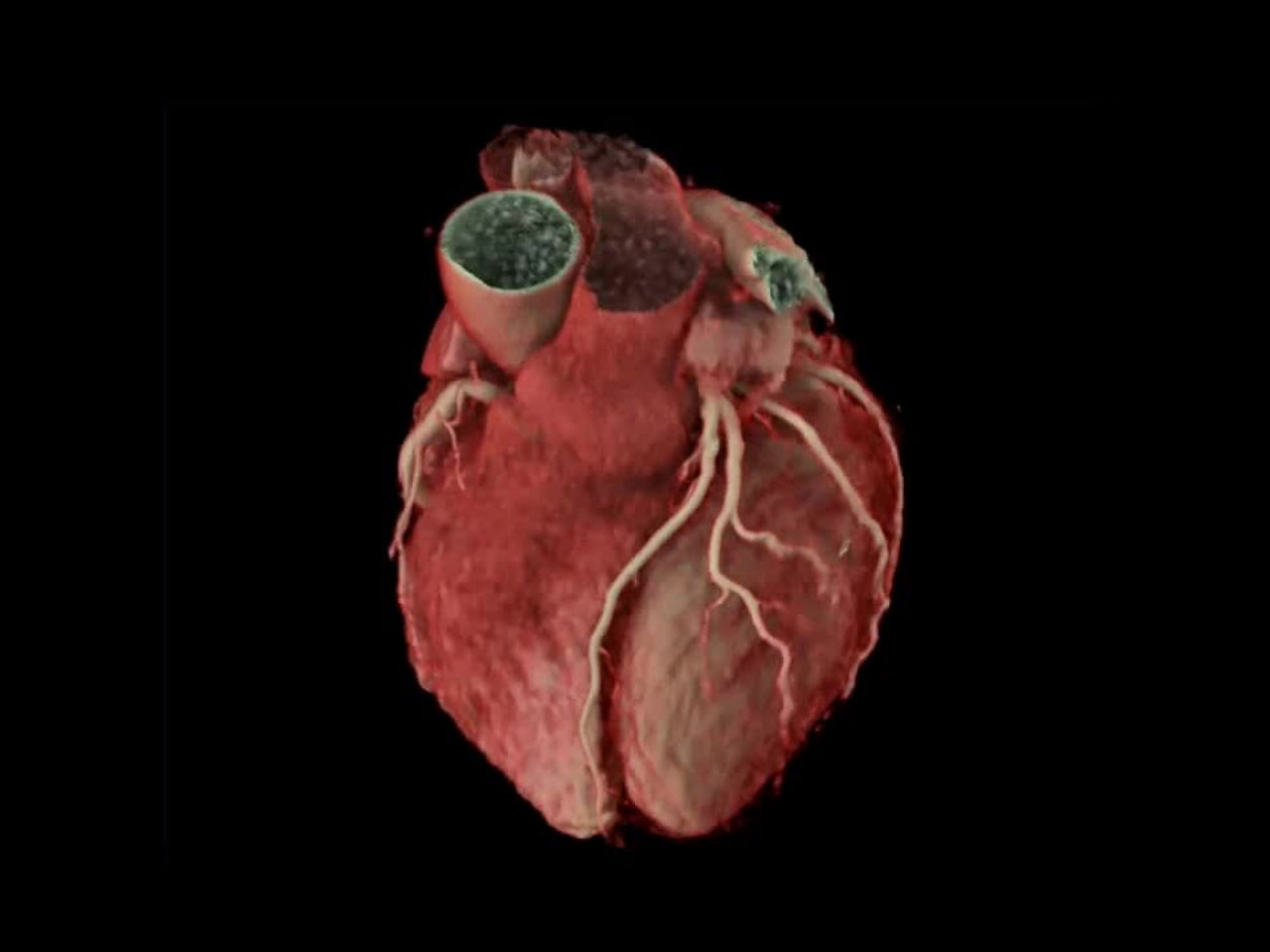 cardiac-ct-ai-enhanced-visualization-thumbnail