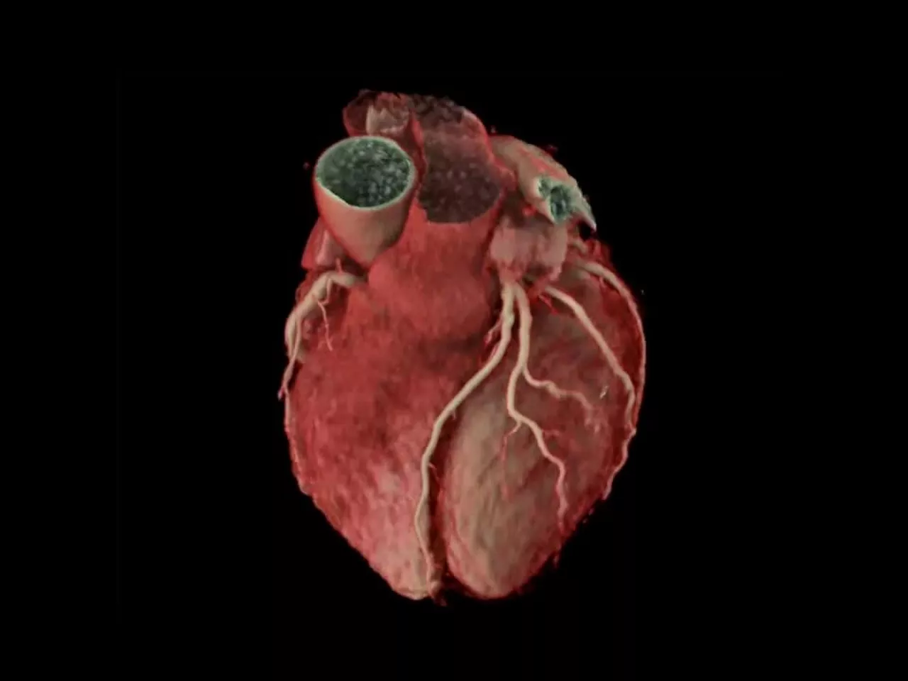 cardiac-ct-ai-enhanced-visualization-thumbnail