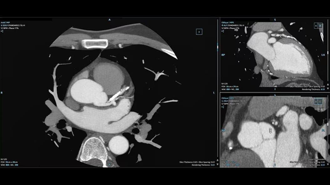 cardiac-ct-cardiq-suite-2-ci-en