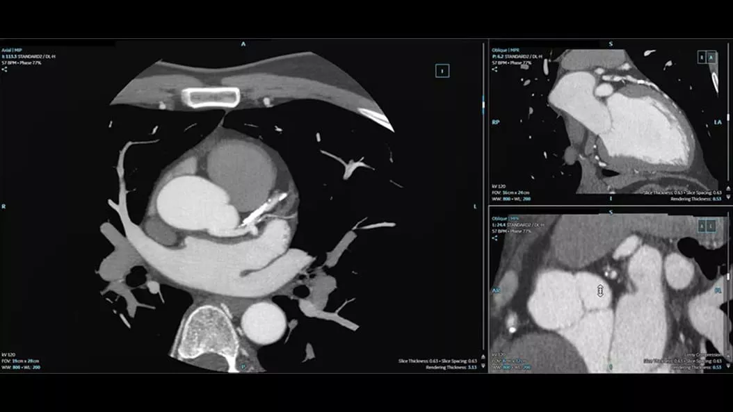 cardiac-ct-cardiq-suite-2-ci-en