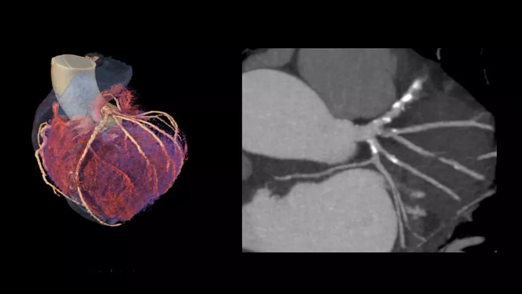 cardiac-ct-revolution-apex-2-ci-en