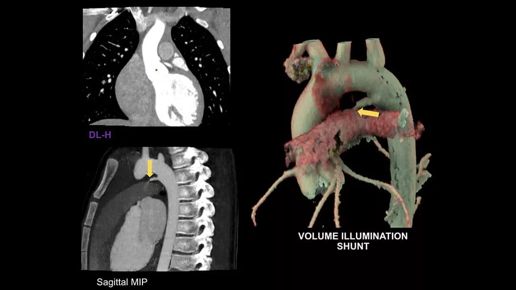 cardiac-ct-revolution-ascend-2-ci-en