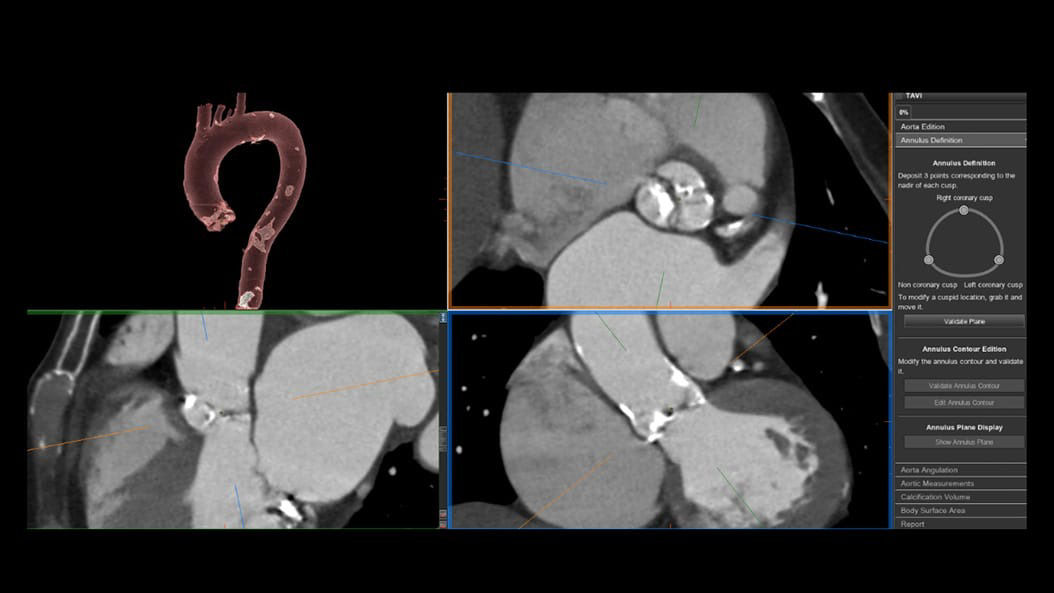 cardiac-ct-revolution-maxima-2-ci-en