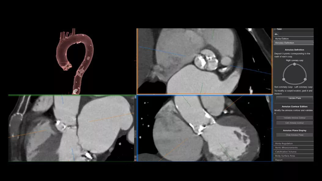cardiac-ct-revolution-maxima-2-ci-en