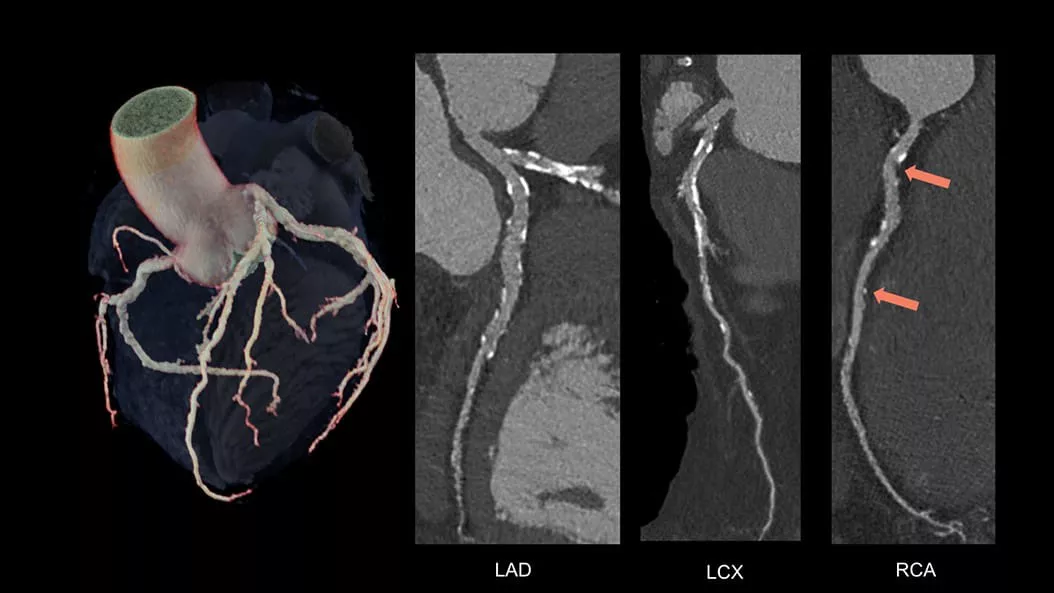 cardiac-ct-revolution-vibe-2-ci-en