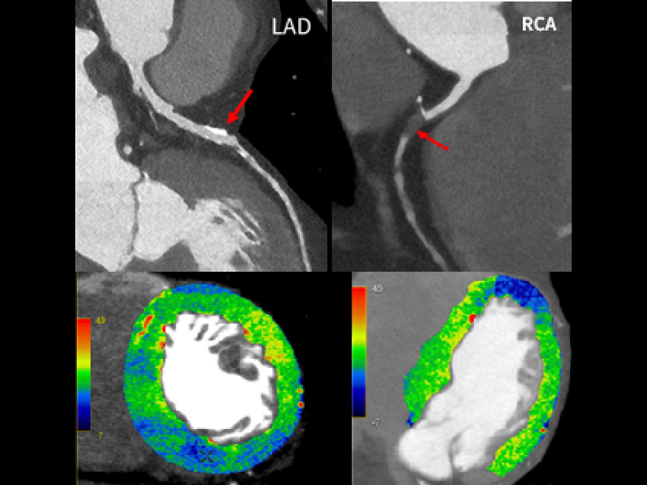 cardiac-ct-spectral-imaging-high-resolution